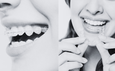 ¿Brackets o alineadores? Qué opción puede ser mejor para ti