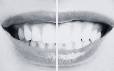 Blanqueamiento dental: mitos y verdades