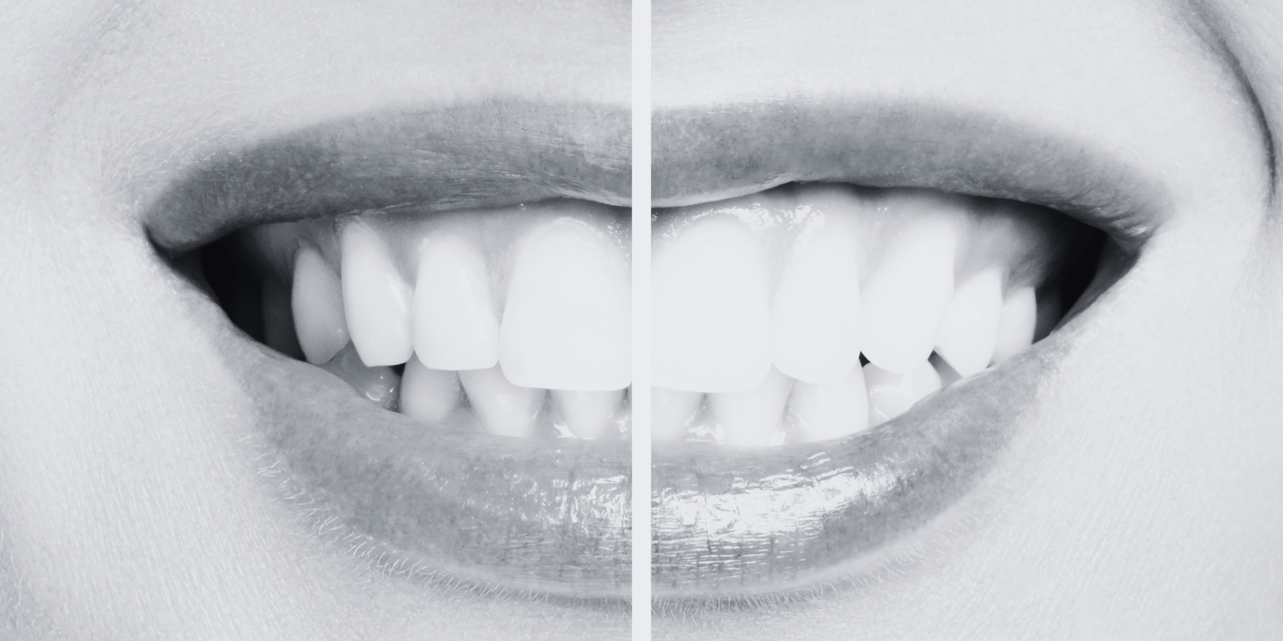 BlanqueamientoDentalAlcobendas