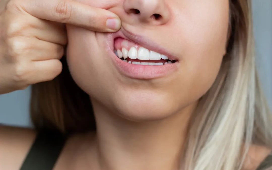 El sangrado de encías: Un indicador clave de la salud periodontal
