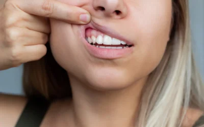 El sangrado de encías: Un indicador clave de la salud periodontal