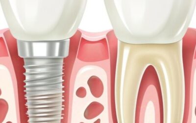 Implantes Dentales con Falta de Hueso
